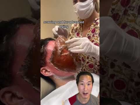 Watch Her Skin Get Lifted Off Her Face! #phenol #chemicalpeel